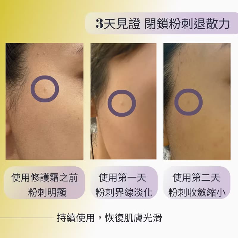 【痘疤粉刺 淨化代謝】活氧抗痘修護霜 解決痘痘粉刺困擾淨膚控油