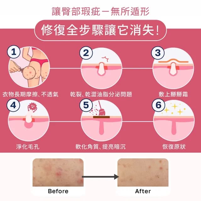 【ELLO】益生菌屁痘掰掰霜 Butt Blemish Cream 55ML(益生菌 臀部瑕疵 粉刺 屁股保養 乳霜)